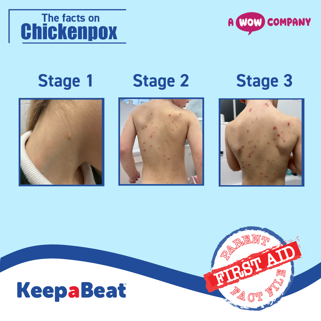 Chickenpox